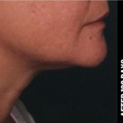 Ultherapy Before & After Patient #1558